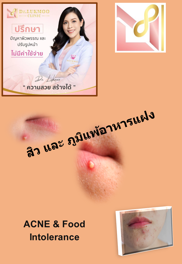 สถาบันความงาม คลินิกหมอลูกหมู. สิว… ไม่ใช่เรื่อง จิ๋ว....